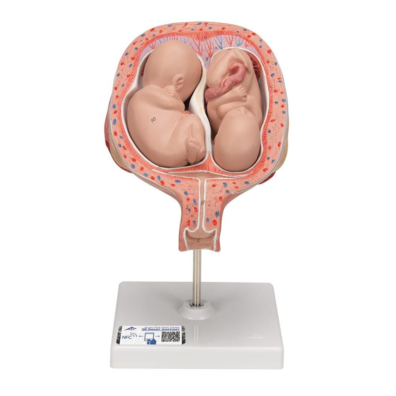 5th Month Twin Fetuses - Normal Position