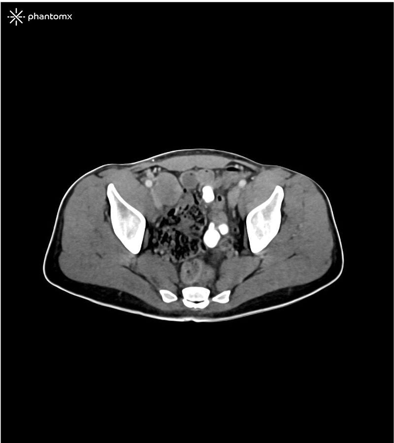 Portal Venous Phase Abdomen and Pelvis Phantom for CT Scan and X-Ray Training