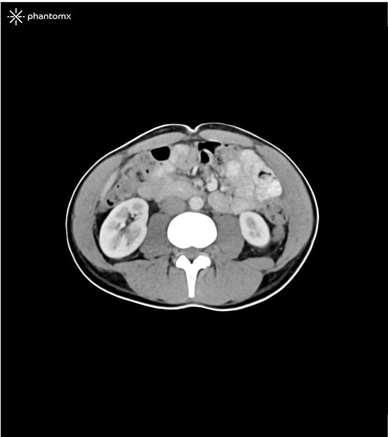 Portal Venous Phase Abdomen and Pelvis Phantom for CT Scan and X-Ray Training