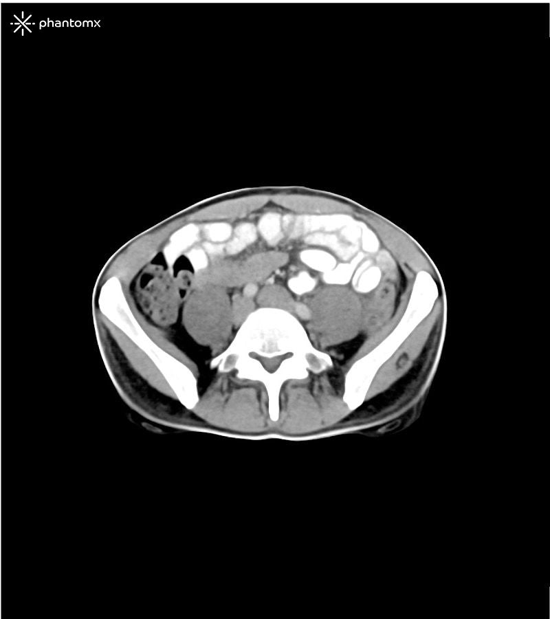 Portal Venous Phase Abdomen and Pelvis Phantom for CT Scan and X-Ray Training