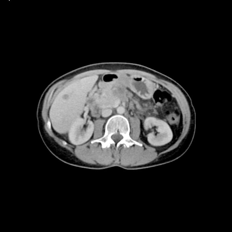 Abdomen Phantom - PV Liver Metastases