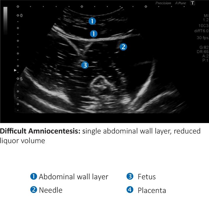 AMNIO ABBY® - Ultrasound Guided Invasive Procedures Simulator