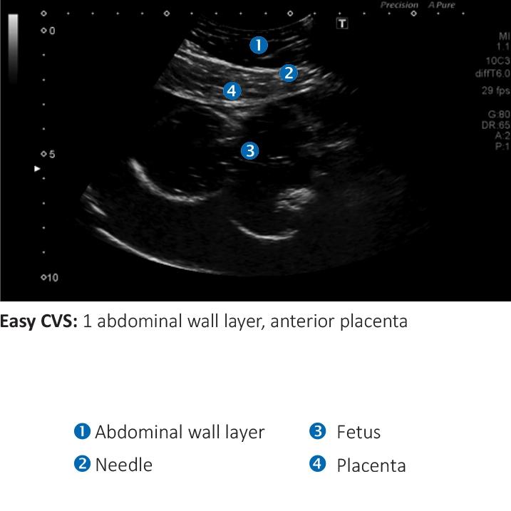 AMNIO ABBY® - Ultrasound Guided Invasive Procedures Simulator