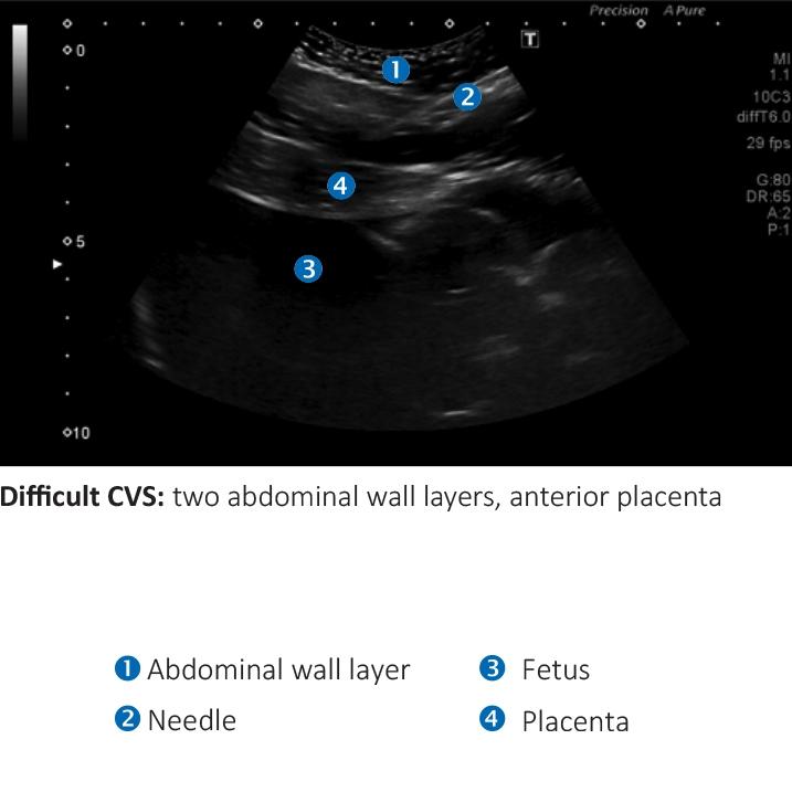AMNIO ABBY® - Ultrasound Guided Invasive Procedures Simulator