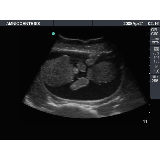 Amniocentesis Ultrasound Training Model
