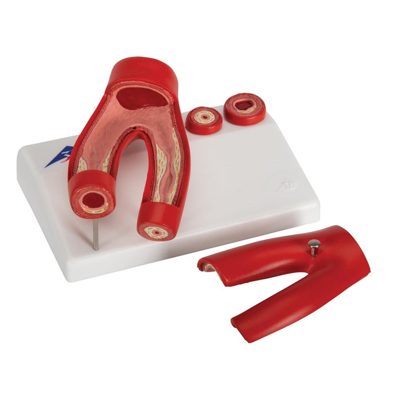 Arteriosclerosis Model, with cross section of artery, 2 part