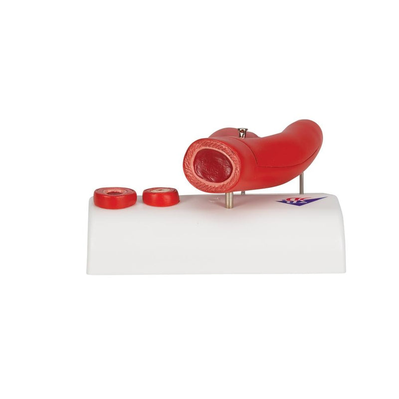 Arteriosclerosis Model, with cross section of artery, 2 part
