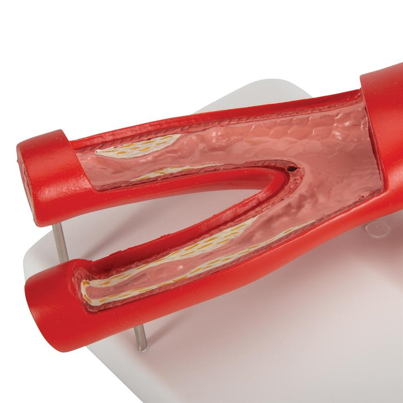 Arteriosclerosis Model, with cross section of artery, 2 part