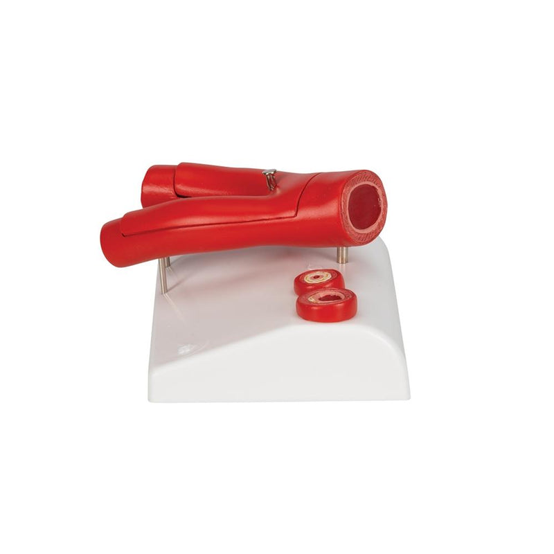 Arteriosclerosis Model, with cross section of artery, 2 part