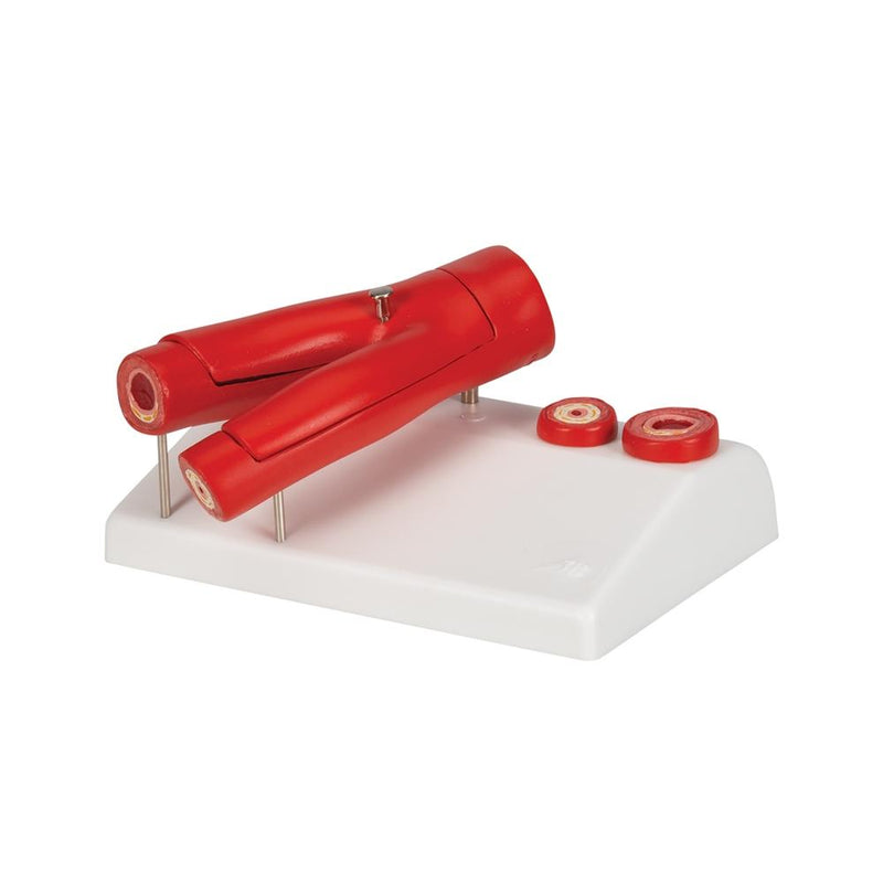 Arteriosclerosis Model, with cross section of artery, 2 part