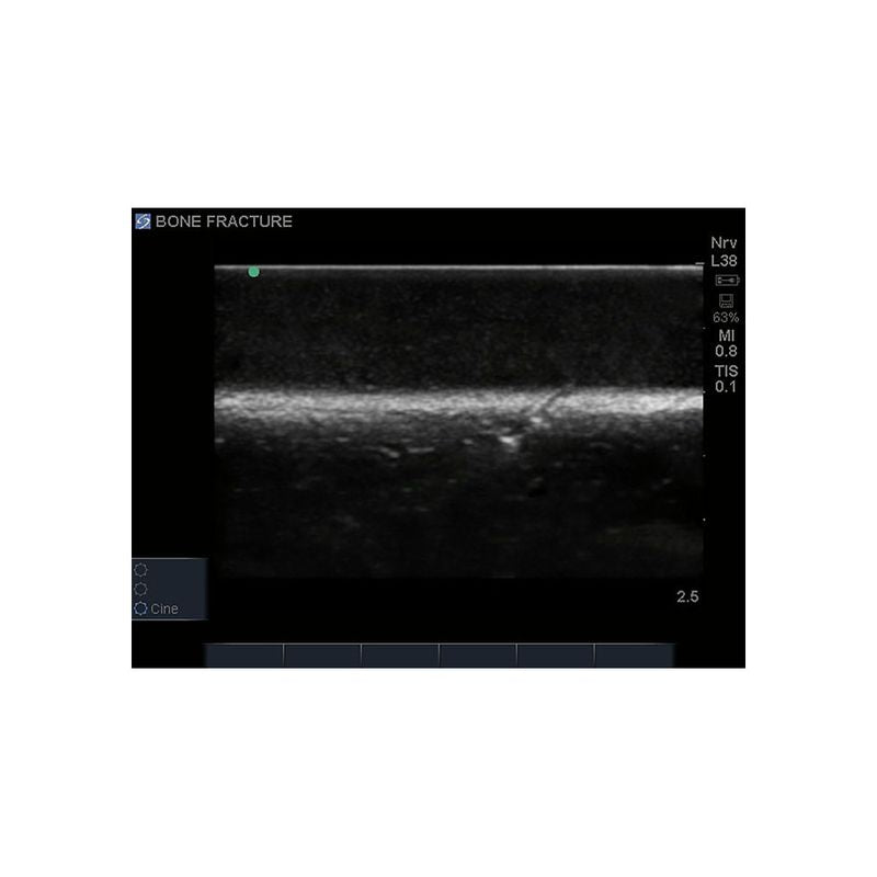 Bone Fracture Ultrasound Training Block, Crepitus Fracture