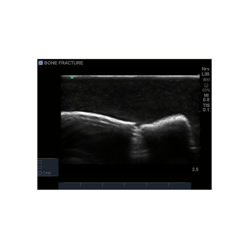 Bone Fracture Ultrasound Training Block, Greenstick Fracture