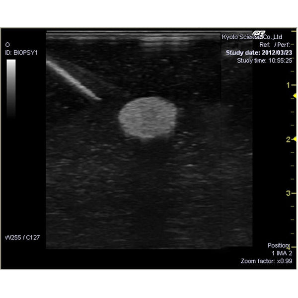 Tumor Puncture Simulation Phantom Ultrasound Tumor Biopsy Training ...