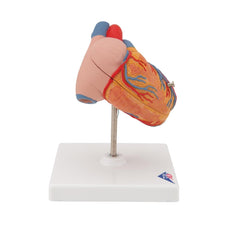 Classic Heart Model with Left Ventricular Hypertrophy (LVH), 2 part
