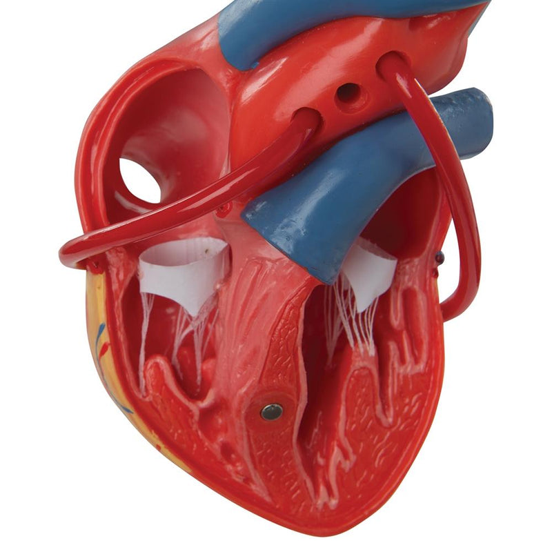 Classic Heart with Bypass, 2 part