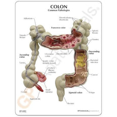 Colon Model with pathologies