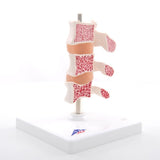 Deluxe Osteoporosis Model