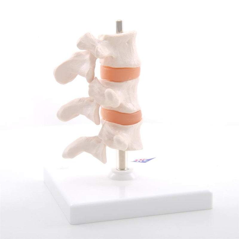 Deluxe Osteoporosis Model