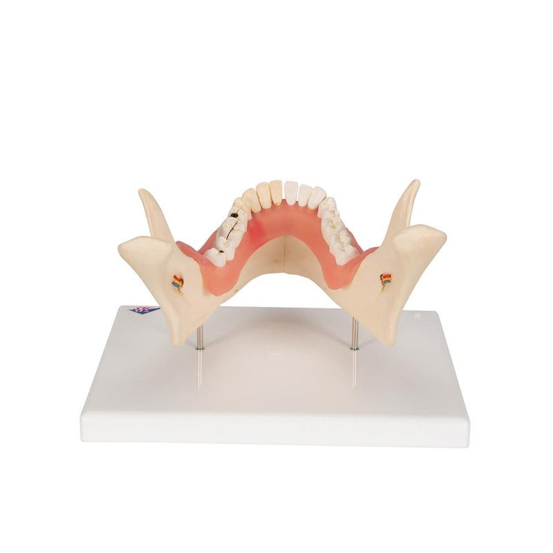 Dental Disease Model, 2x magnified, 21 parts