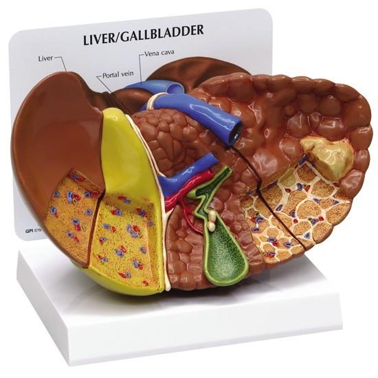 Diseased Liver (Cancer) Anatomy Model