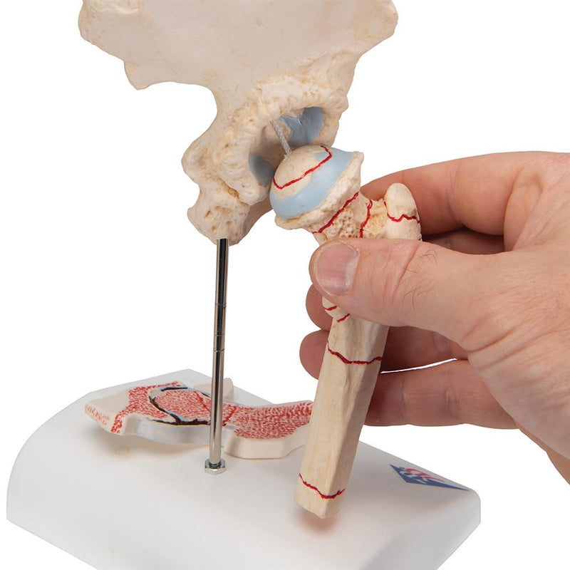Femoral Fracture and Hip Osteoarthritis Model