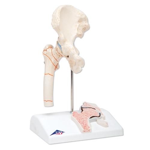 Femoral Fracture and Hip Osteoarthritis Model