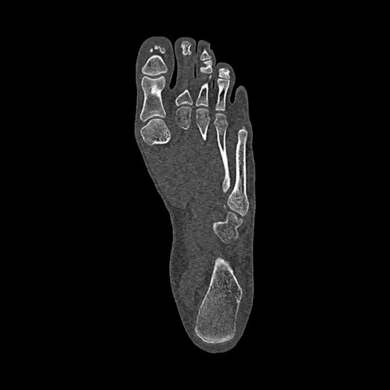 Foot Phantom Metatarsal Fractures