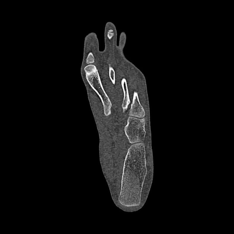 Foot Phantom Metatarsal Fractures