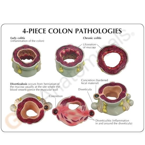 Four Piece Colon Model with Pathologies
