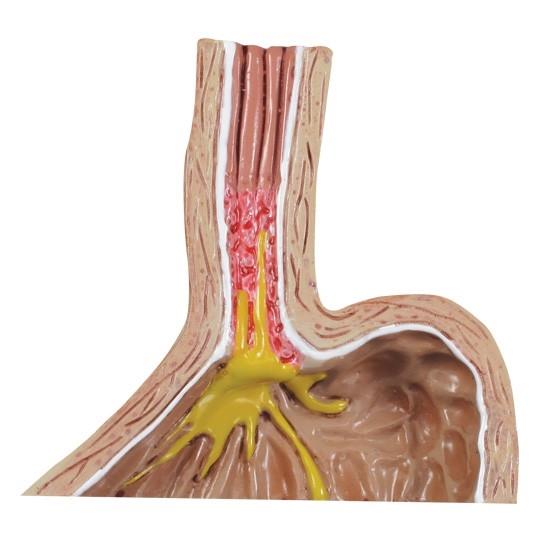GastroEsophageal Reflux Disease Model (GERD) GP2010 – GTSimulators.com