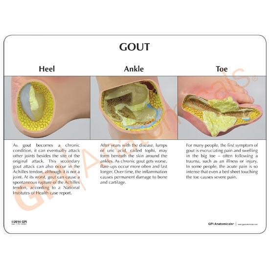Gout Foot Model