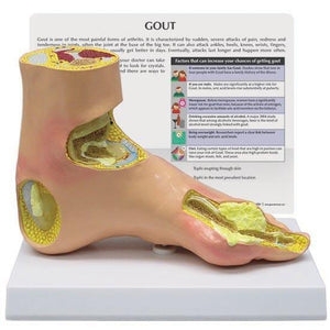 Gout Foot Model