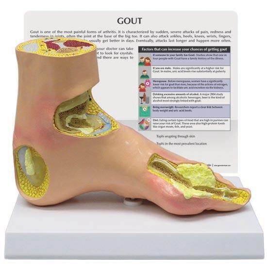 Gout Foot Model –1
