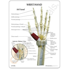 Hand and Wrist with Carpal Tunnel Syndrome
