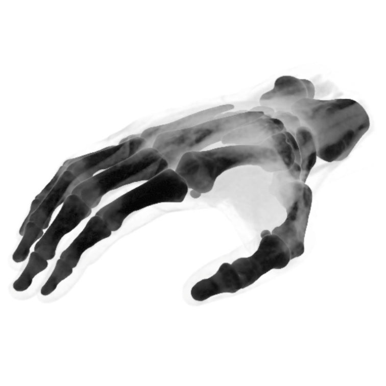 Hand Phantom Metacarpal Fractures