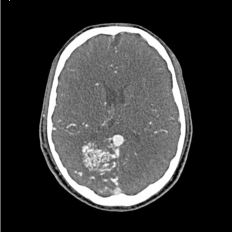 CTA AVM / lesion Head and Neck Phantom for CT Scan and X-Ray Training