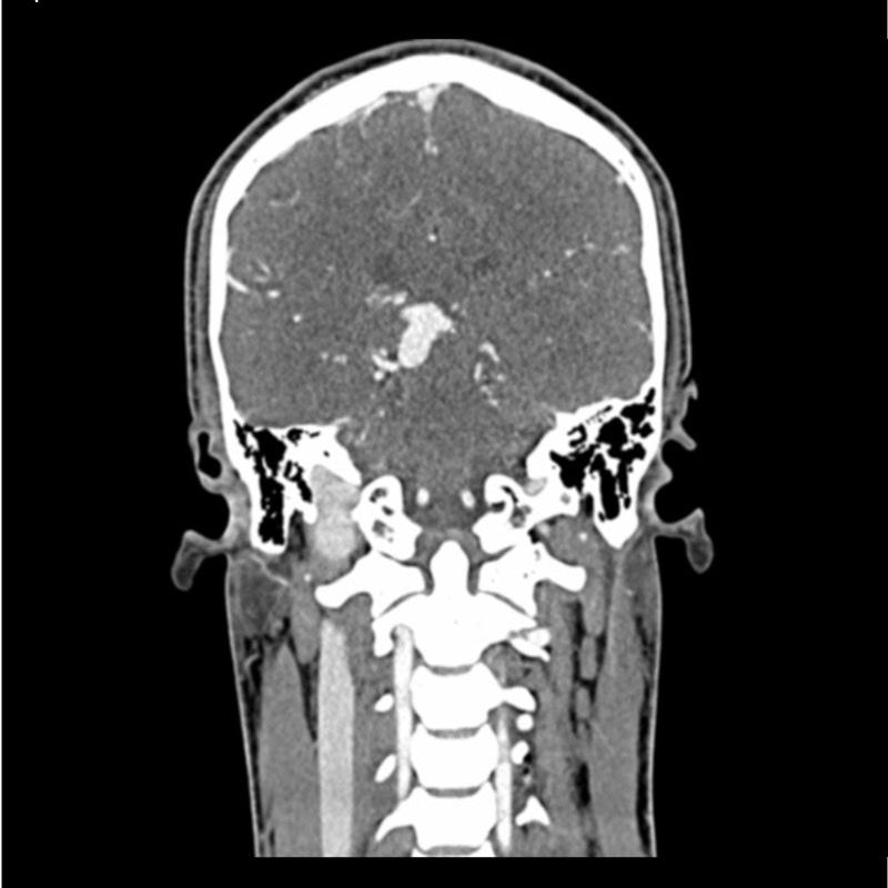 CTA AVM / lesion Head and Neck Phantom for CT Scan and X-Ray Training