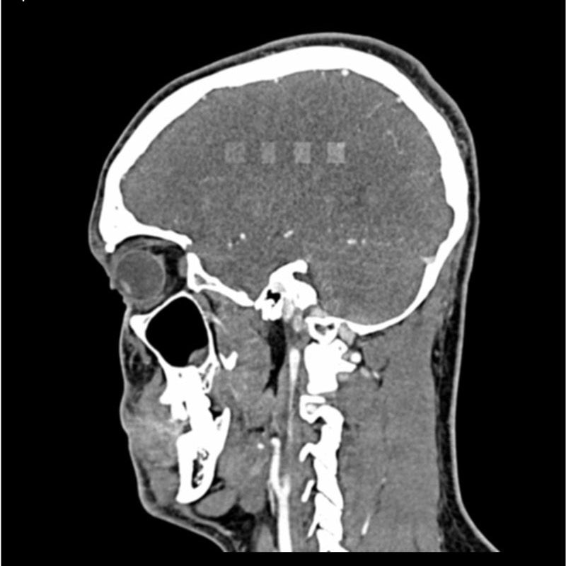 CTA AVM / lesion Head and Neck Phantom for CT Scan and X-Ray Training