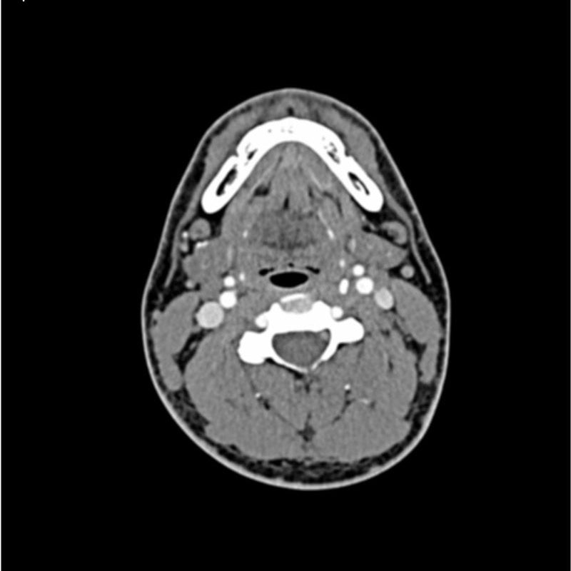 Neck Phantom CTA AVM / lesion Head and Neck Phantom for CT Scan and X-Ray Training ...
