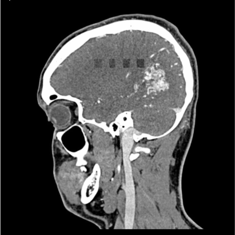 CTA AVM / lesion Head and Neck Phantom for CT Scan and X-Ray Training