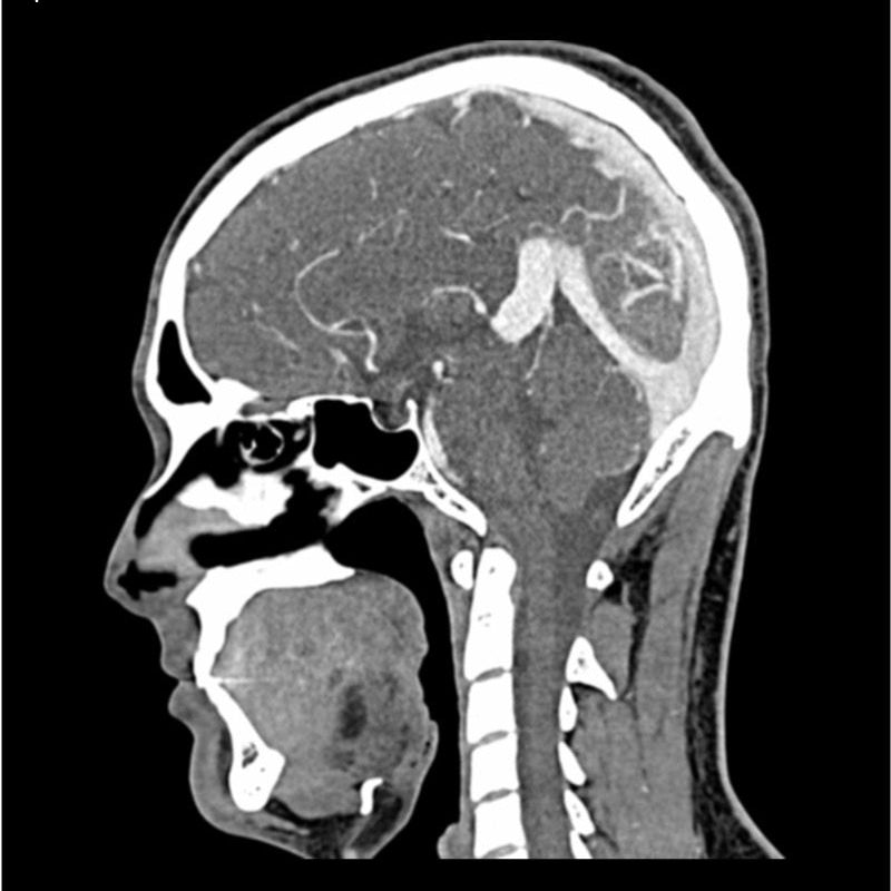 CTA AVM / lesion Head and Neck Phantom for CT Scan and X-Ray Training