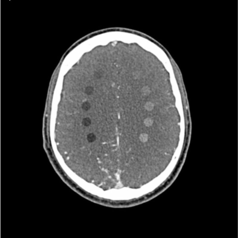 CTA AVM / lesion Head and Neck Phantom for CT Scan and X-Ray Training