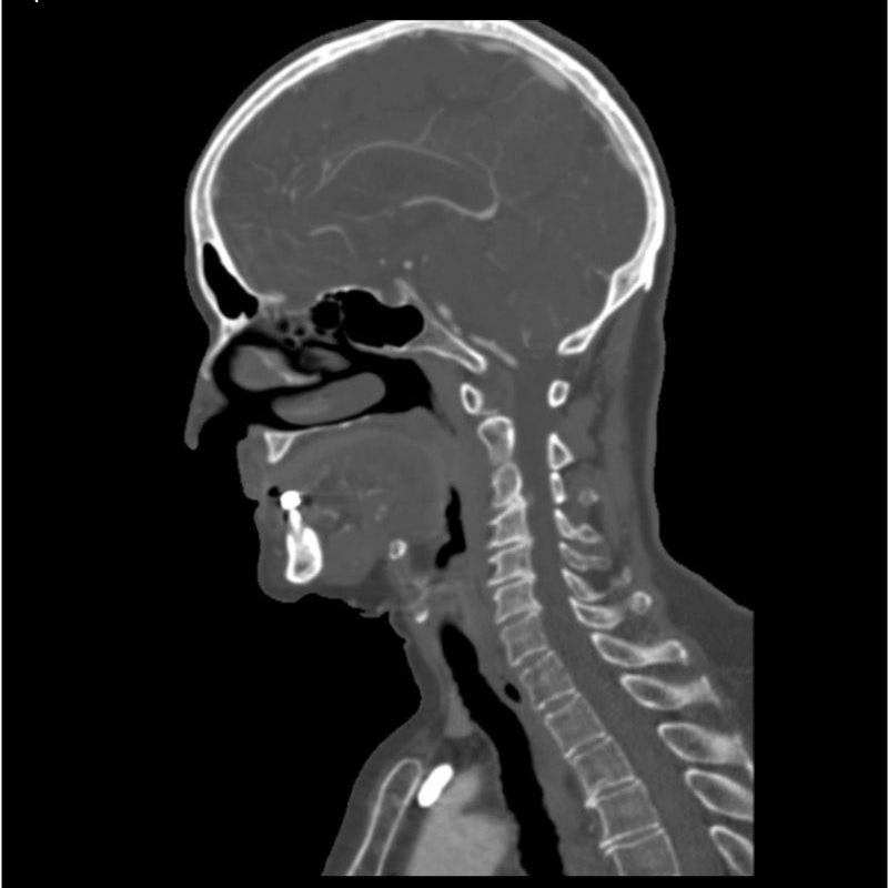 CTA Head and Neck Phantom for CT Scan and X-Ray Training