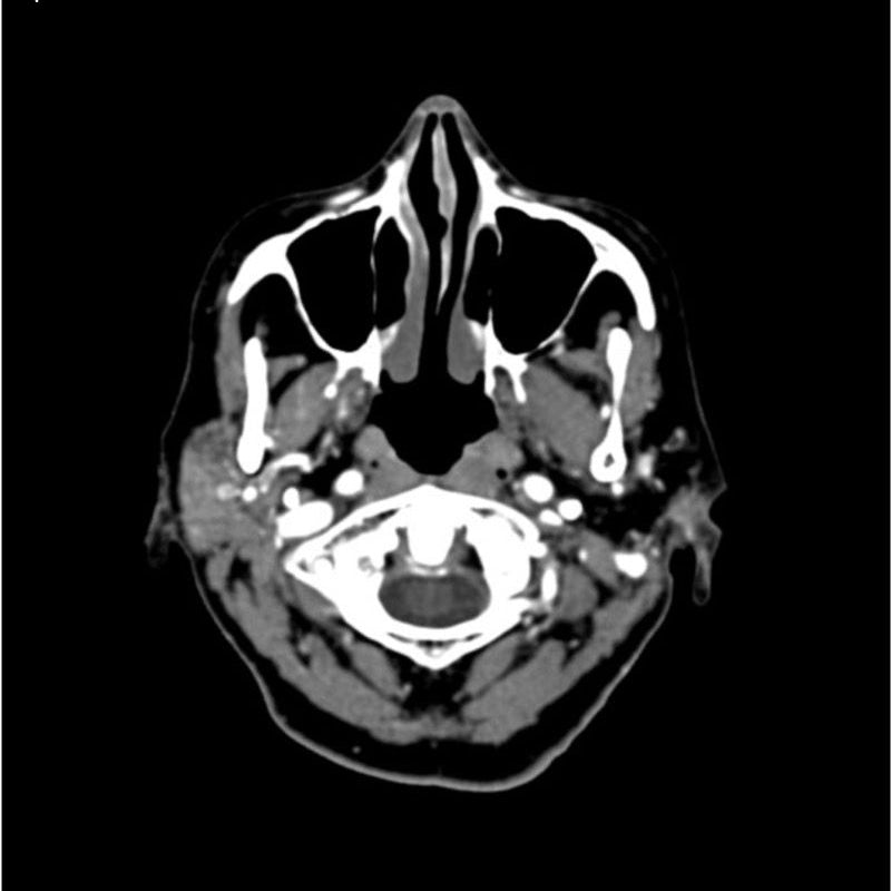 CTA Head and Neck Phantom for CT Scan and X-Ray Training