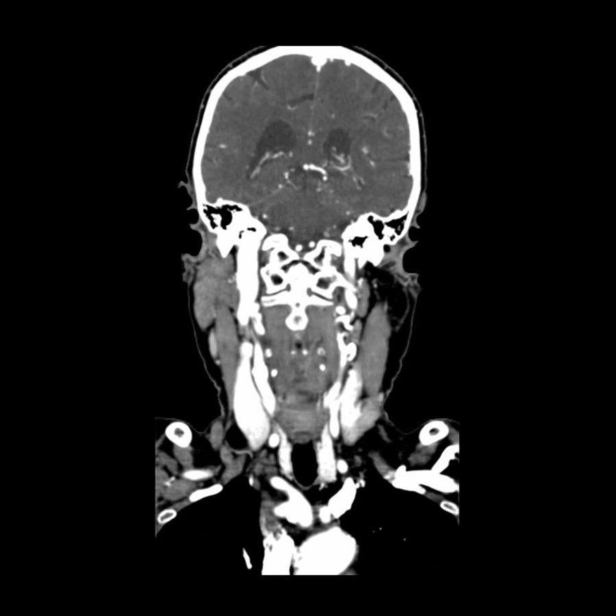 Neck Phantom CTA Head and Neck Phantom for CT Scan and X-Ray Training – GTSimulators.com