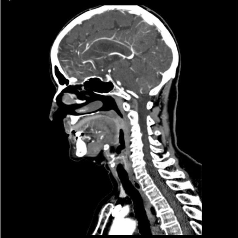 Neck Phantom CTA Head and Neck Phantom for CT Scan and X-Ray Training – GTSimulators.com