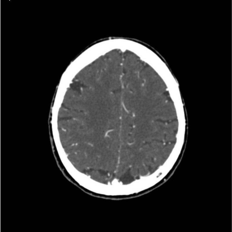CTA Head and Neck Phantom for CT Scan and X-Ray Training