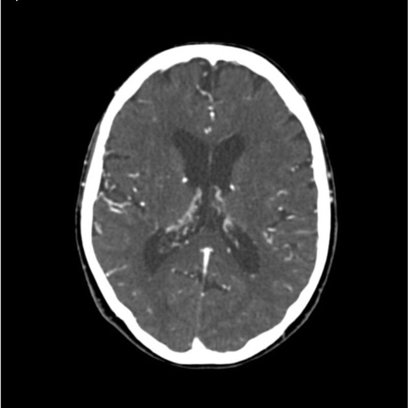 CTA Head and Neck Phantom for CT Scan and X-Ray Training