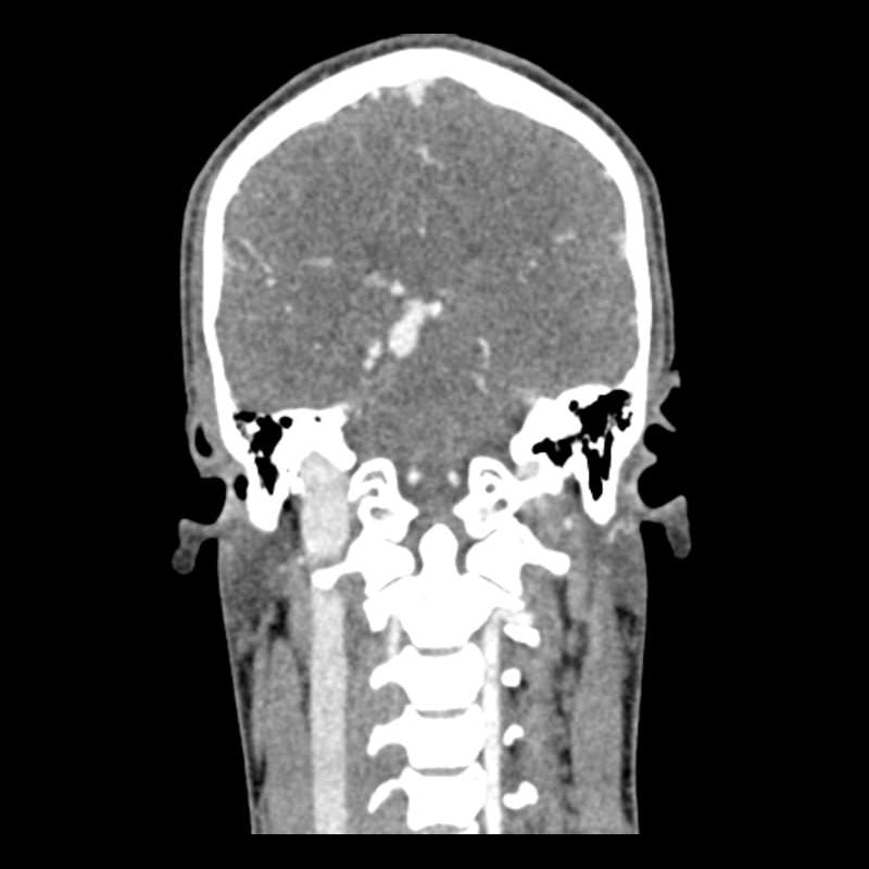 Head And Neck Phantom For Ct, X-Ray And Radiation Therapy