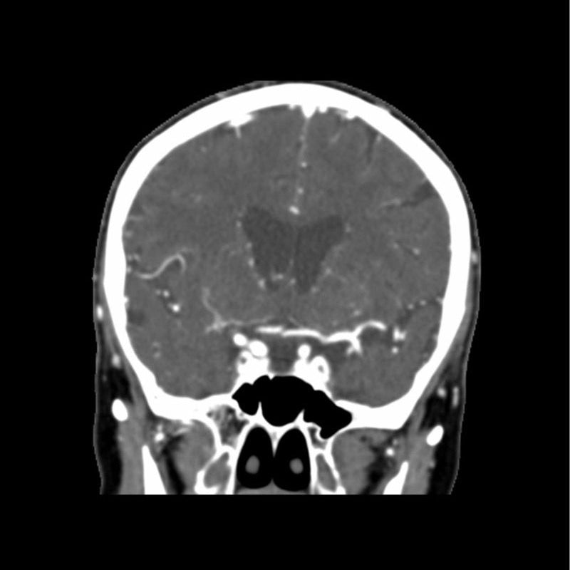CTA Head Phantom for CT Scan and X-Ray Training